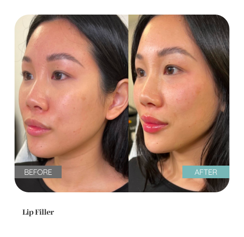 Before and after treatment result — Dr. Lanna, LC Medical Aesthetics NYC